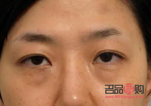 切眼袋后注意事項(去眼袋手術(shù)警惕三大后遺癥)