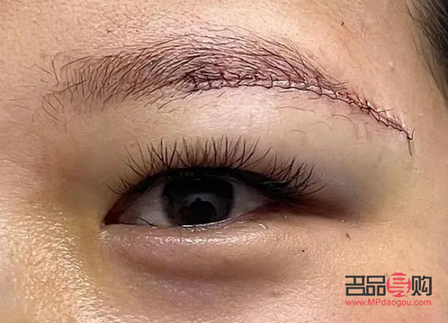 眼皮下垂是提眉好還是割雙眼皮好(眼皮下垂是提眉好還是割雙眼皮好呢)