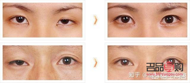 大小眼自我矯正方法最快最有效(大小眼自我矯正方法最快最有效視頻)