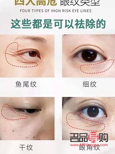 眼睛下邊長(zhǎng)皺紋是怎么回事(眼睛下邊長(zhǎng)皺紋是怎么回事兒)