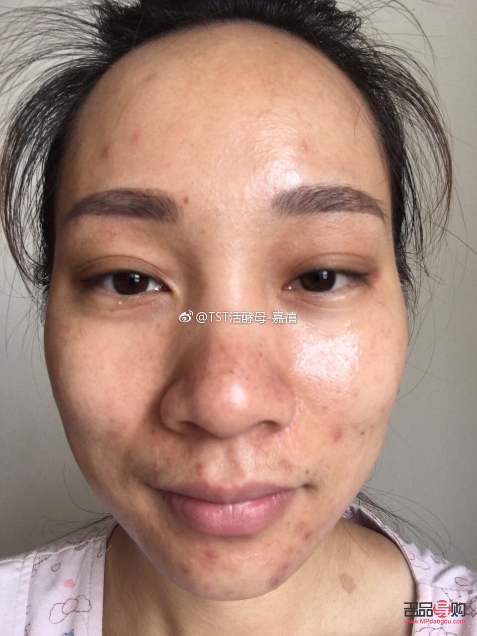 <h3>痘痘彩妝遮蓋術(shù)，重拾肌膚自信</h3>