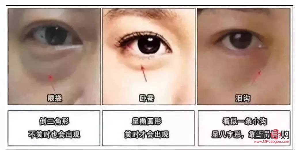 眼輪匝肌折疊臥蠶再造(眼輪匝肌折疊臥蠶再造圖片)