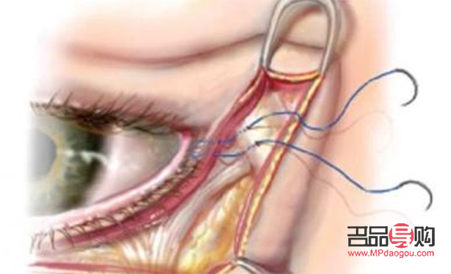 眼輪匝肌折疊臥蠶再造(眼輪匝肌折疊臥蠶再造圖片)