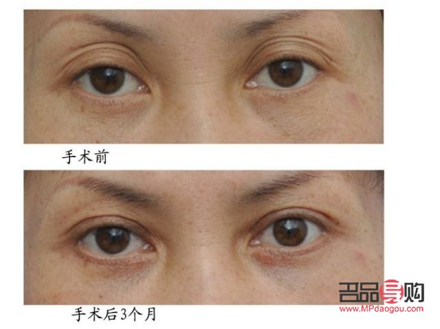 四十歲雙眼皮下垂了怎么辦(四十多歲變雙眼皮了)