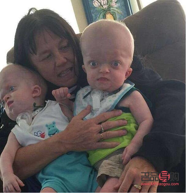 眼睛鼓突出如何改善(眼睛鼓突出是什么原因)