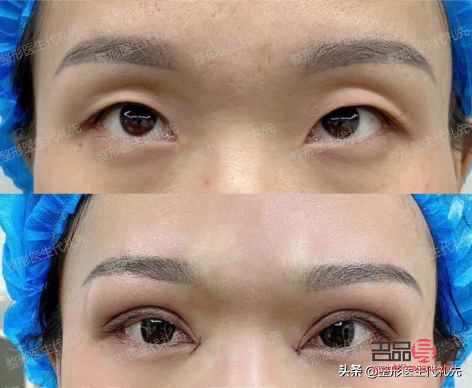 <h3>提眉與雙眼皮：哪個(gè)效果更佳？</h3>