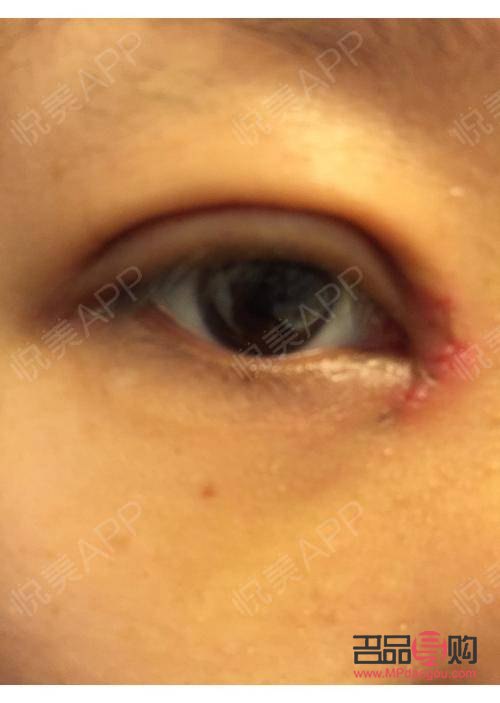 眼角痛一眨眼就痛一按也痛怎么辦(眼角痛一眨眼就痛一按也痛怎么辦可以用唇膏嗎)