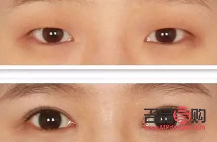 提拉眼皮的正確方法(提拉眼皮的正確方法醫(yī)美)
