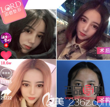 芭比眼綜合是屬于什么型(芭比眼綜合是屬于什么型狀的)