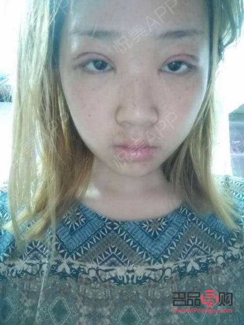 芭比眼綜合是屬于什么型(芭比眼綜合是屬于什么型狀的)