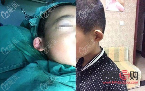 對眼矯正手術(shù)多少錢22歲(對眼矯正手術(shù)價格)