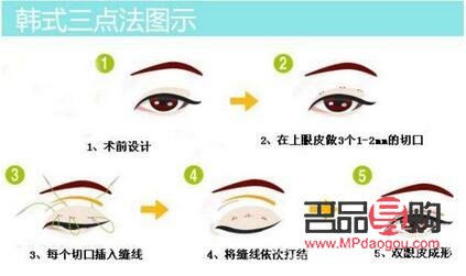 雙眼皮三點(diǎn)定位是什么意思(雙眼皮三點(diǎn)定位好嗎)