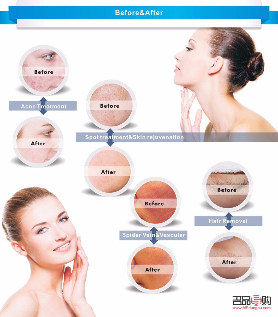 <h3>身體激光后的護(hù)理指南</h3>