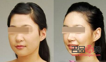 脂肪型腫眼泡怎么消除(脂肪型腫眼泡怎么消除 知乎)