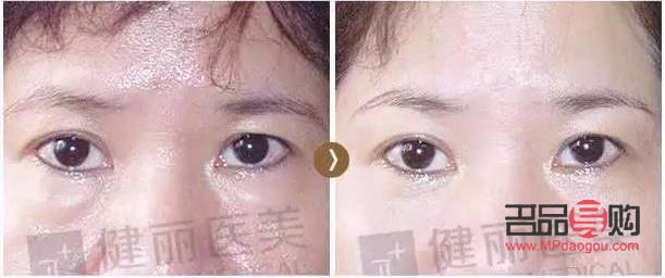 脂肪型腫眼泡怎么消除(脂肪型腫眼泡怎么消除 知乎)