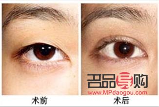 <h3>整容眼睛需要多少錢一次？了解眼部整形費用及考量因素</h3>