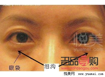 淚溝跟眼袋一樣嗎(淚溝跟眼袋一樣嗎怎么消除)