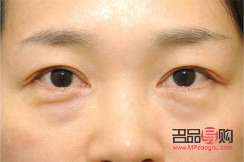 淚溝跟眼袋一樣嗎(淚溝跟眼袋一樣嗎怎么消除)