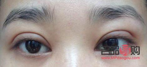 雙眼皮手術(shù)風險大不大(雙眼皮手術(shù)風險大不大知乎)