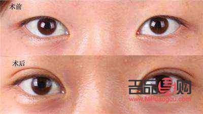 眼皮松塌怎么辦(眼皮松塌怎么辦小妙招)