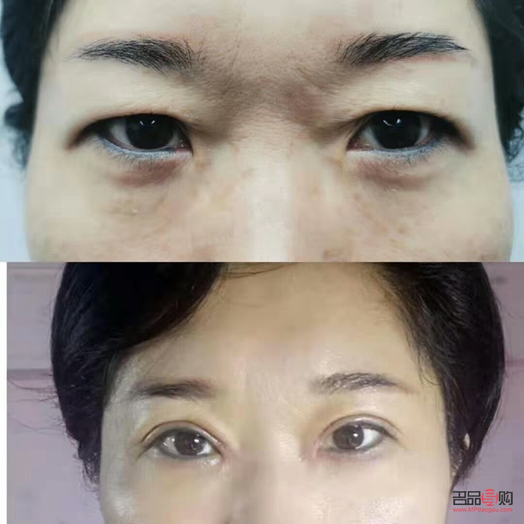 眼皮松塌怎么辦(眼皮松塌怎么辦小妙招)