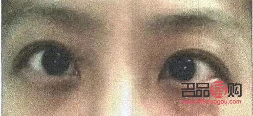 <h3>斗雞眼矯正手術康復時間詳解</h3>