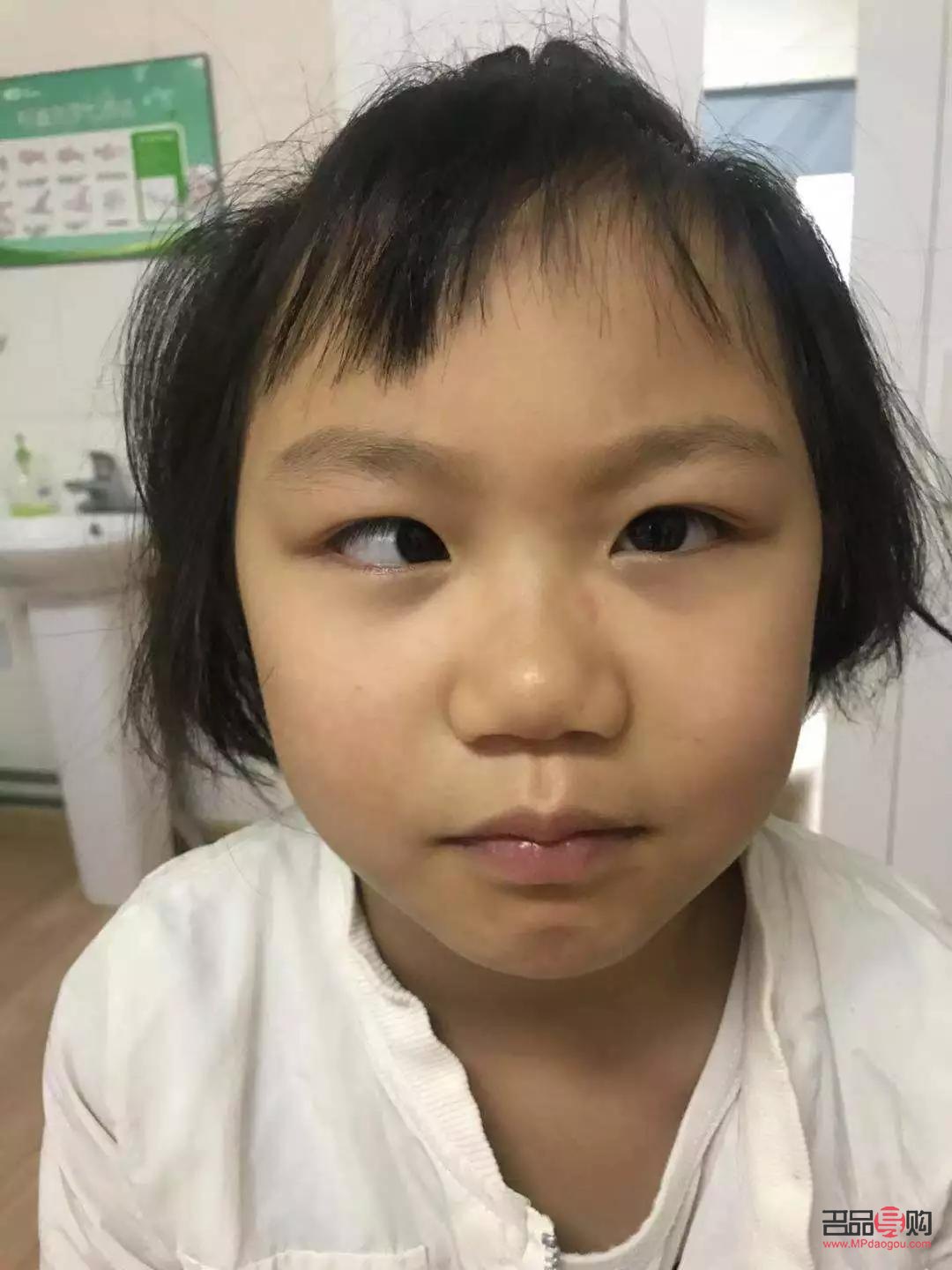 斗雞眼矯正手術(shù)康復(fù)時間詳解