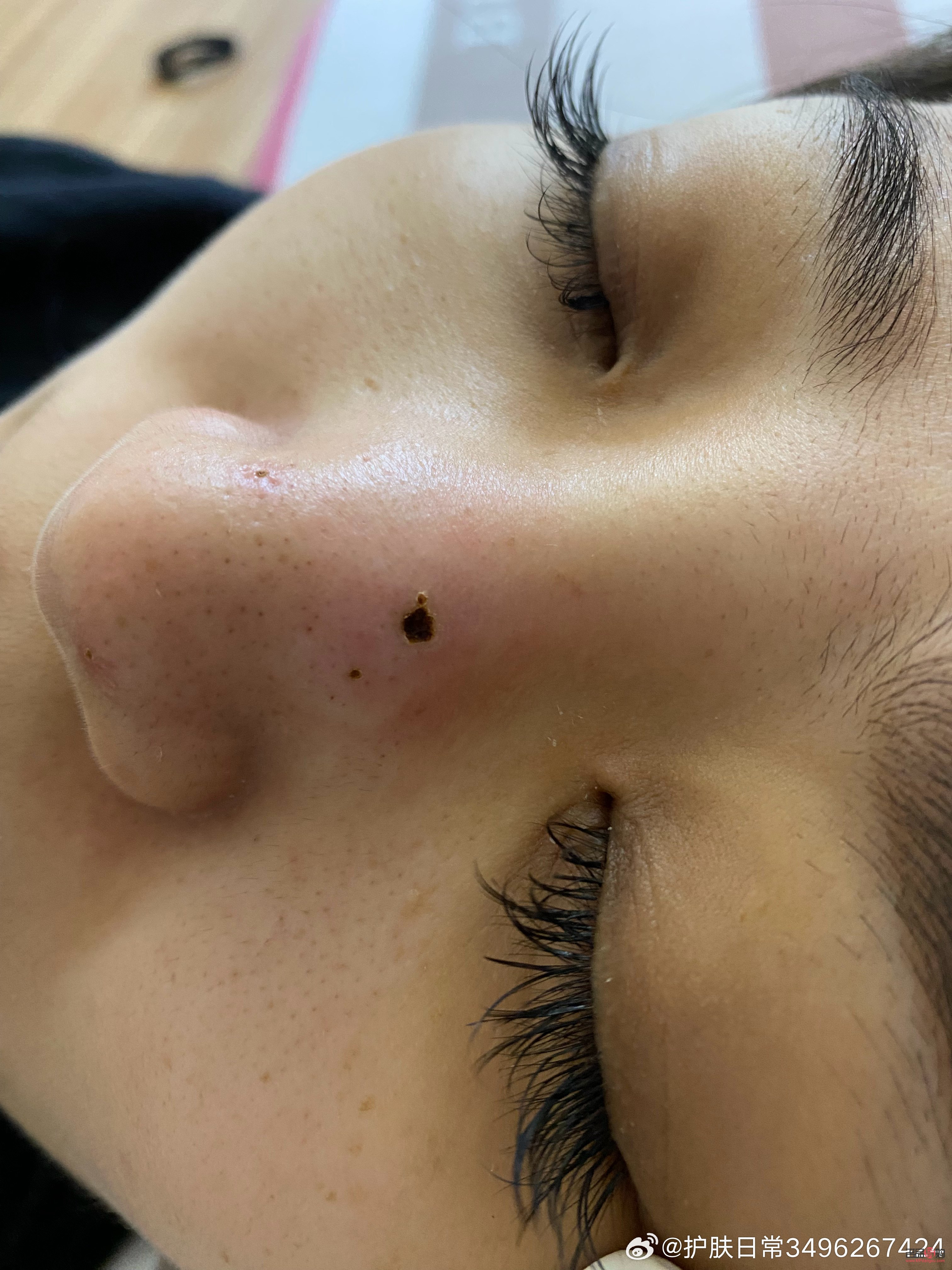 <h3>點(diǎn)痣美容院：專業(yè)操作與安全保障</h3>