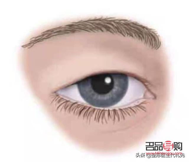上眼皮松弛有皺紋怎么辦圖片(上眼皮松弛有皺紋怎么辦圖片大全)
