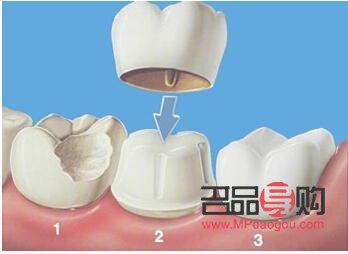 美容冠壞了怎么辦(美容冠壞了怎么辦圖片)