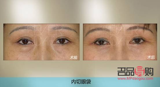 鄭州割眼袋手術(shù)費一般是多少(鄭州割眼袋手術(shù)費一般是多少錢)