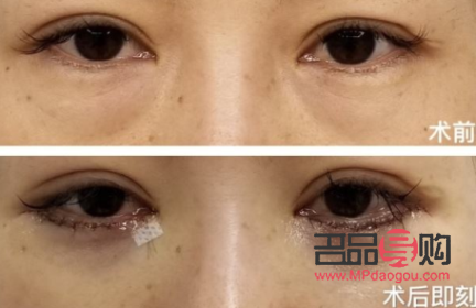 鄭州割眼袋手術(shù)費(fèi)一般是多少(鄭州割眼袋手術(shù)費(fèi)一般是多少錢)