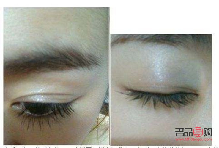 <h3>雙眼皮手術：如何選擇最佳方案？</h3>