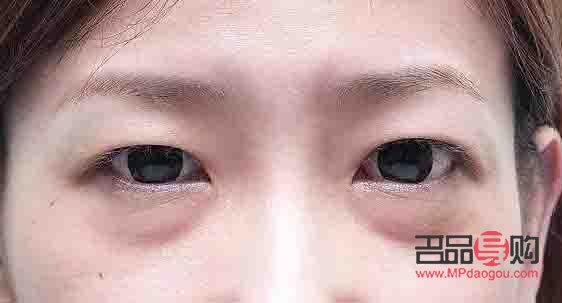 眼袋的照片(眼袋照片)