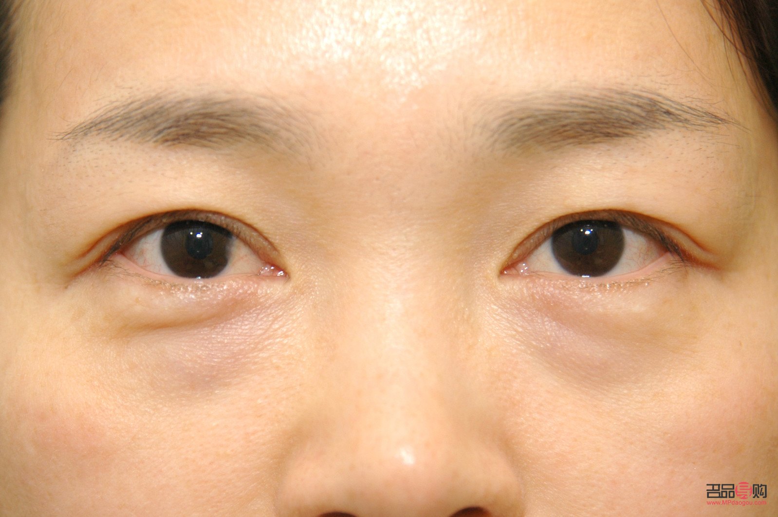 眼袋的照片(眼袋照片)