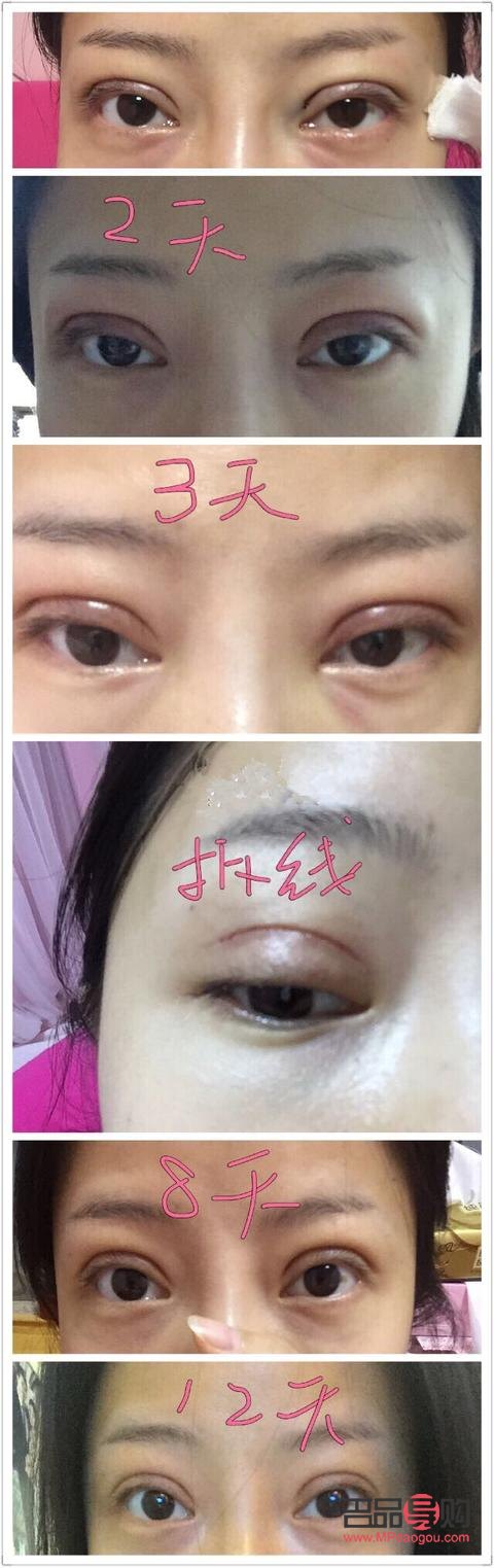 雙眼皮埋線恢復(fù)期與辣食攝入指南
