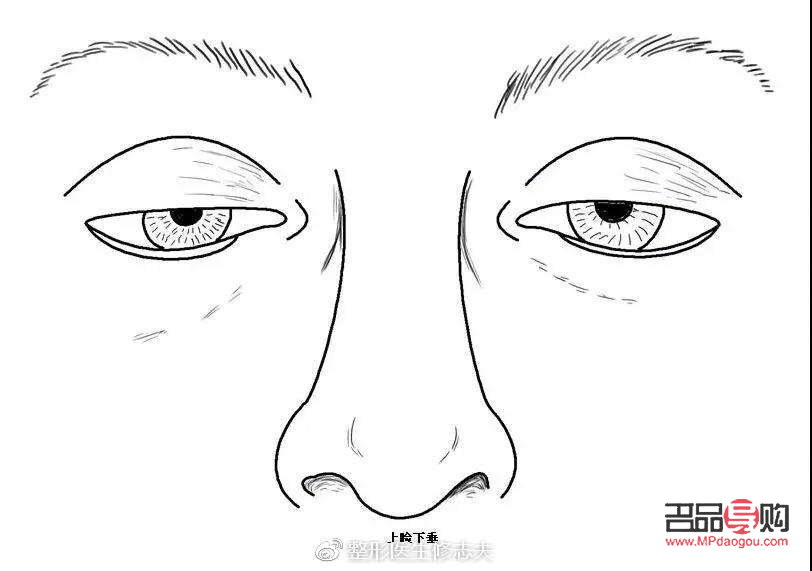 <h3>眼睛肌無力：探尋治愈之路</h3>