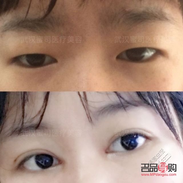 <h3>眼睛肌無力：探尋治愈之路</h3>