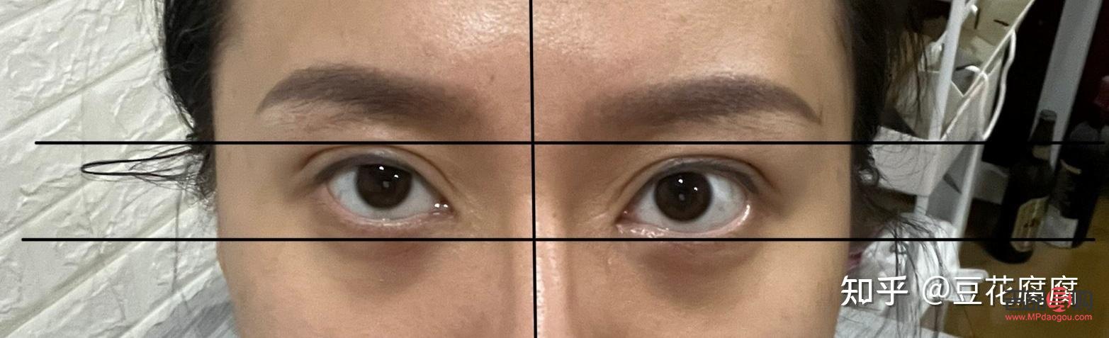 <h3>眼睛高低不對(duì)稱怎么辦？專業(yè)解答與實(shí)用建議</h3>