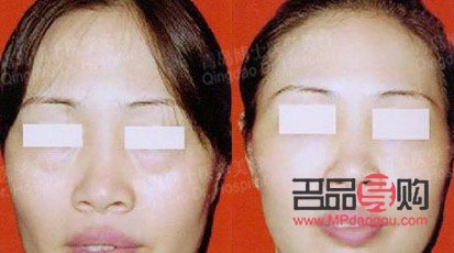 做大小眼手術(shù)要多少錢(做大小眼手術(shù)要多少錢費用)