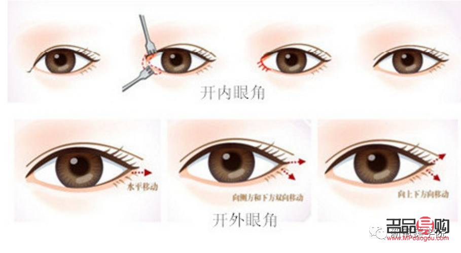 開眼角多少錢大概(開眼角多少錢?)