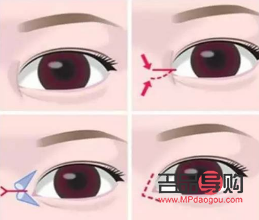 開眼角多少錢大概(開眼角多少錢?)