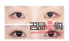 開眼角多少錢大概(開眼角多少錢?)