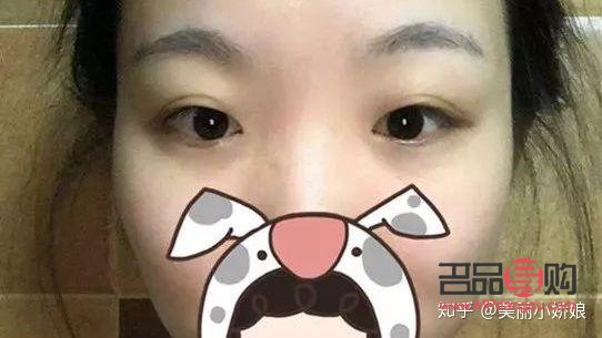 全切雙眼皮與半切雙眼皮：選擇之美