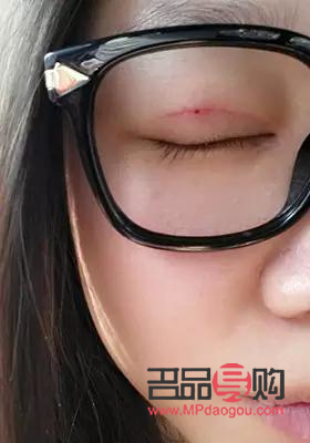 全切雙眼皮與半切雙眼皮：選擇之美