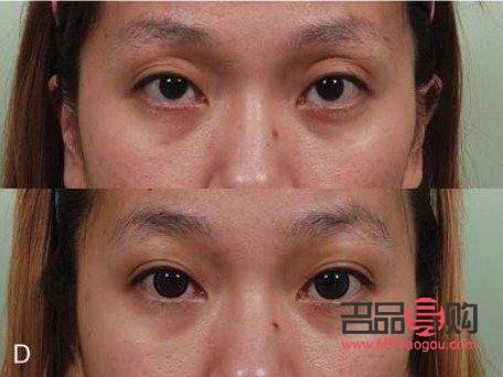 <h3>眼窩凹陷填充脂肪價格解析</h3>