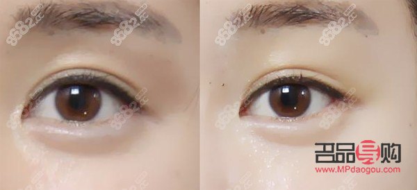 <h3>眼窩凹陷填充脂肪價格解析</h3>