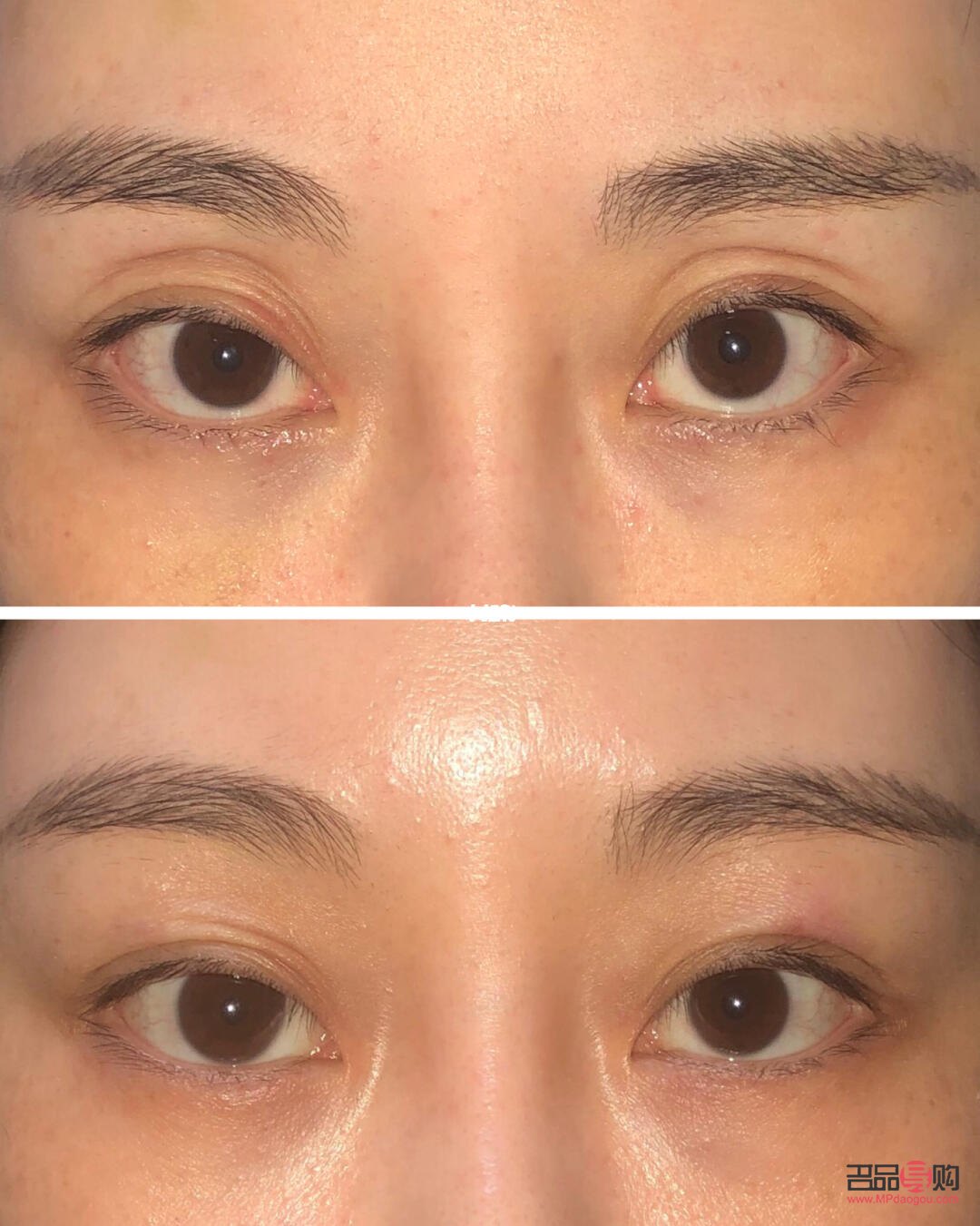 <h3>眼窩凹陷填充脂肪價格解析</h3>