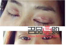 雙眼皮定點(diǎn)是怎么弄的(雙眼皮定點(diǎn)是什么)