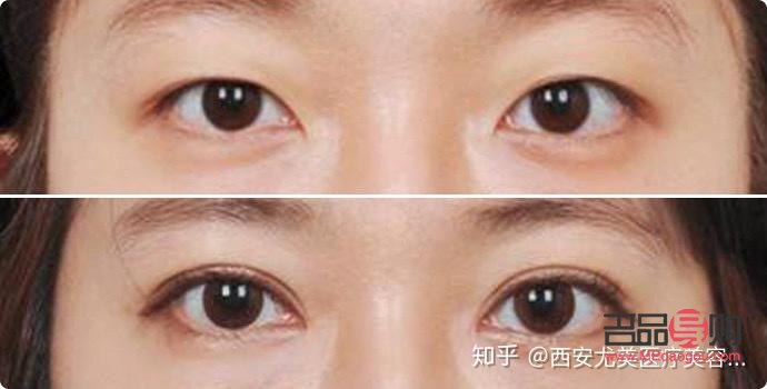 雙眼皮定點(diǎn)是怎么弄的(雙眼皮定點(diǎn)是什么)